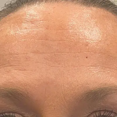 Forehead smoothing after