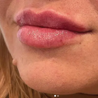 Lip augmentation after