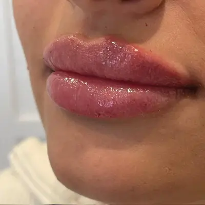 Lip enhancement after