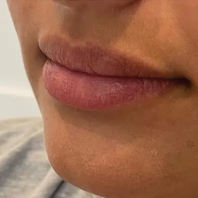 Lip enhancement before