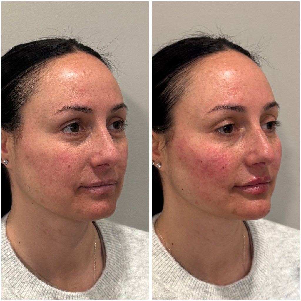 Facial balancing before and after
