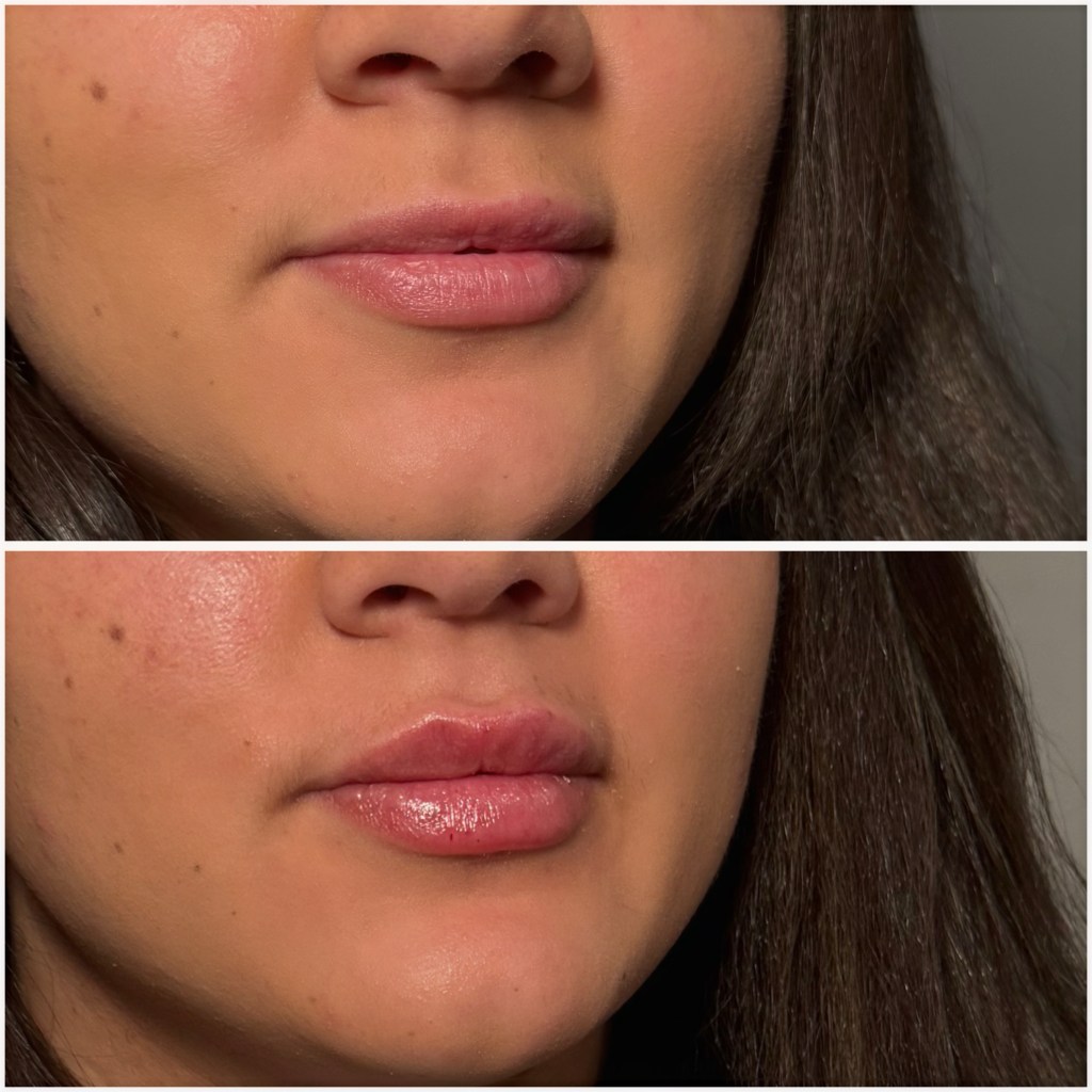 Lip filler before and after