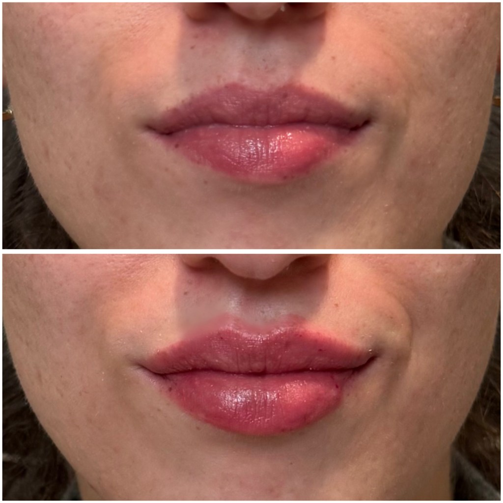 Lip filler before and after