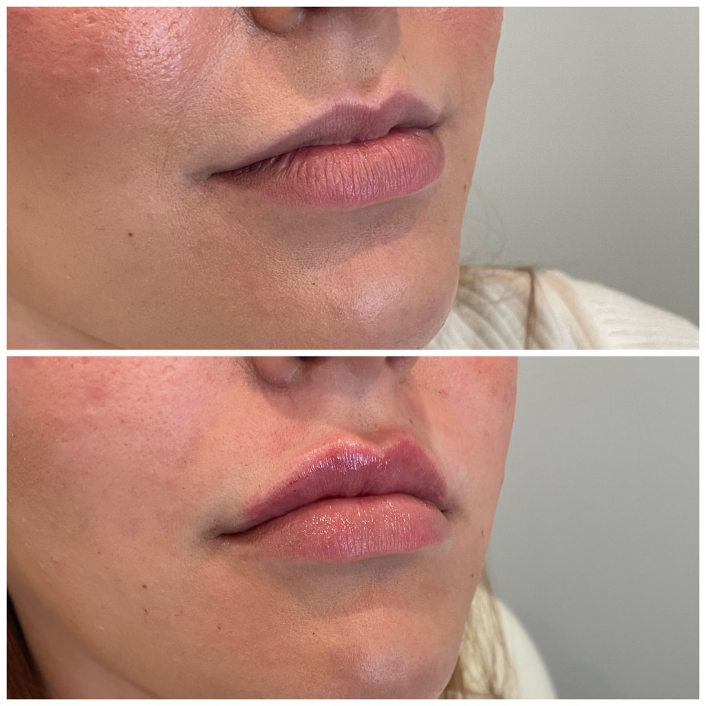 Lip filler before and after