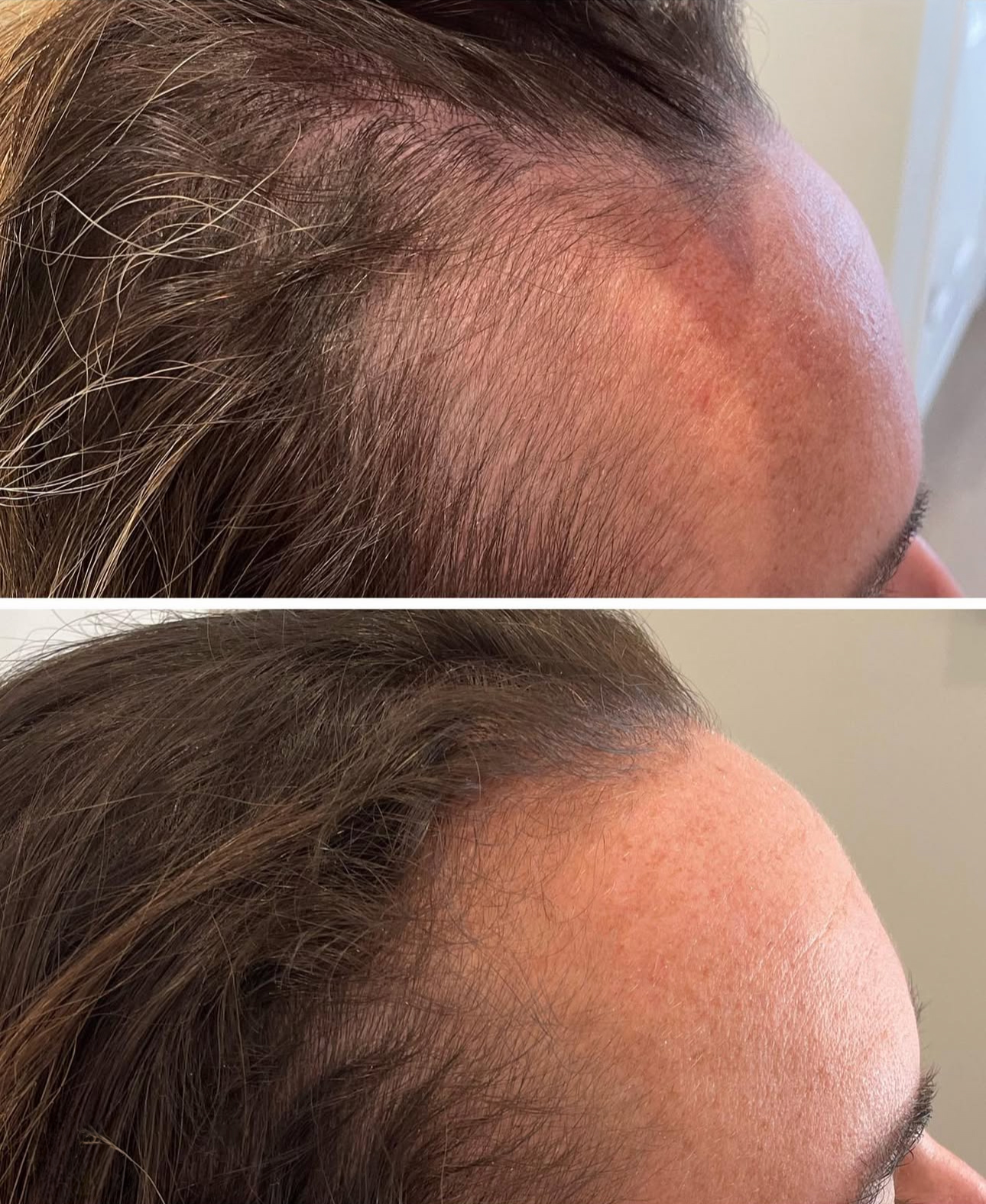 PRP hair restoration before and after
