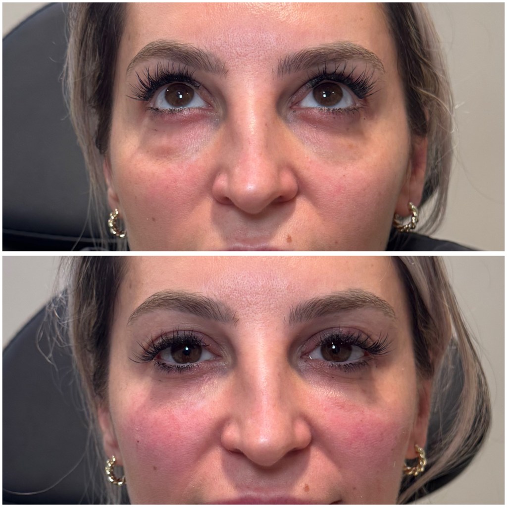 Under eye rejuvenation before and after