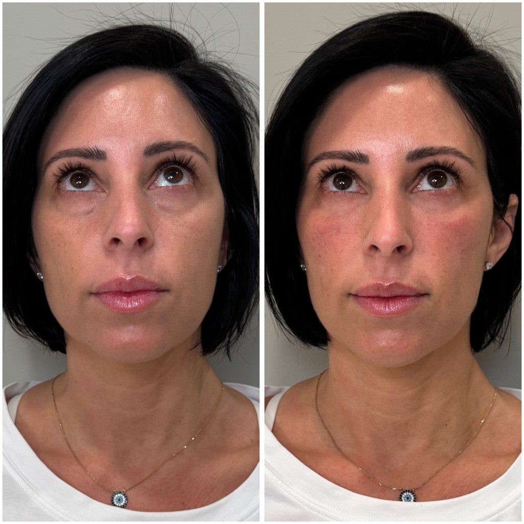 Under eye rejuvenation before and after